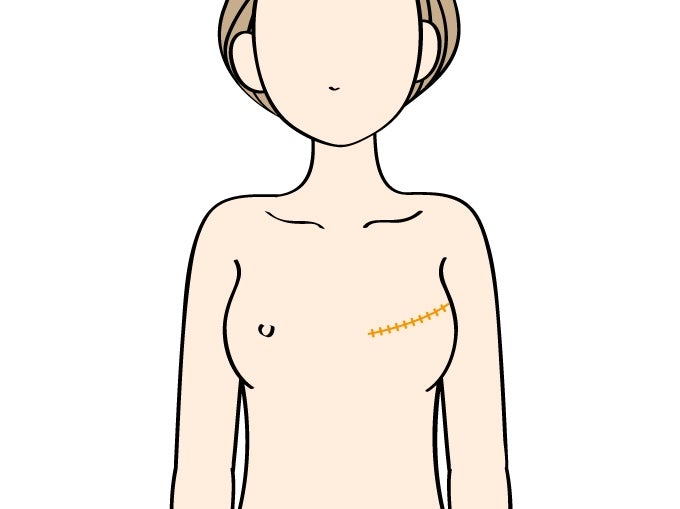 乳がん遺伝性検査は受けるべき?受けて損はない!